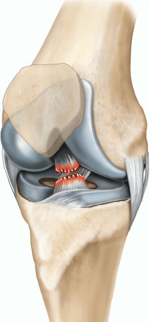 acl-reconstruction-illustration-bb7e2a-AQEJ2Vly4QhpVBey