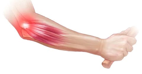 ds00469_im00373_mcdc7_tennis_elbow_jpg.jpg-m5Kr45Dplri2Blve