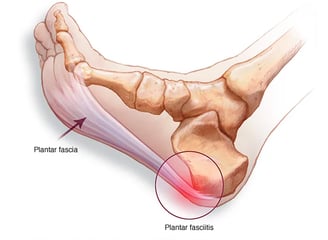 ds00508_im00939_r7_fasciitisthu_jpg(1).jpg-d95rlM6Eg9UgVeye - copia
