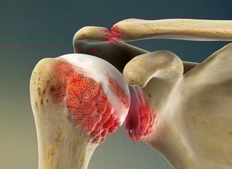 rheumatoidarthritisshoulder_1280-m7VpDgZ2vXhbEe2Z(1)