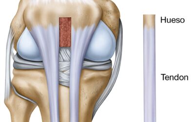 Cuando reconstruimos el ligamento cruzado anterior, ¿que tendones utilizamos para ello?